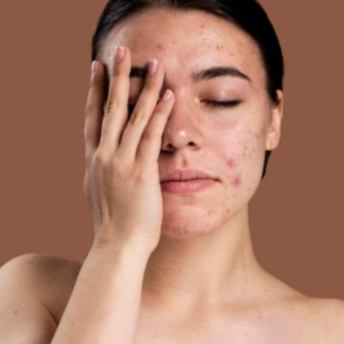 Дерматолог Энгельгардт перечислила продукты, из-за которых обостряются все кожные проблемы